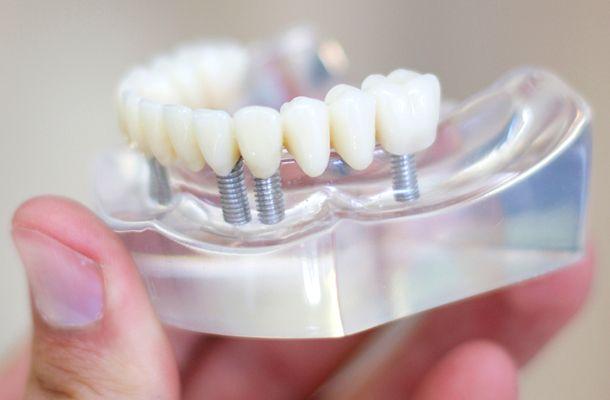 dental implants in Gosnells