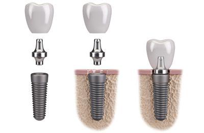 Dental implant abutment and crown