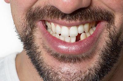 missing tooth - dental emergencies