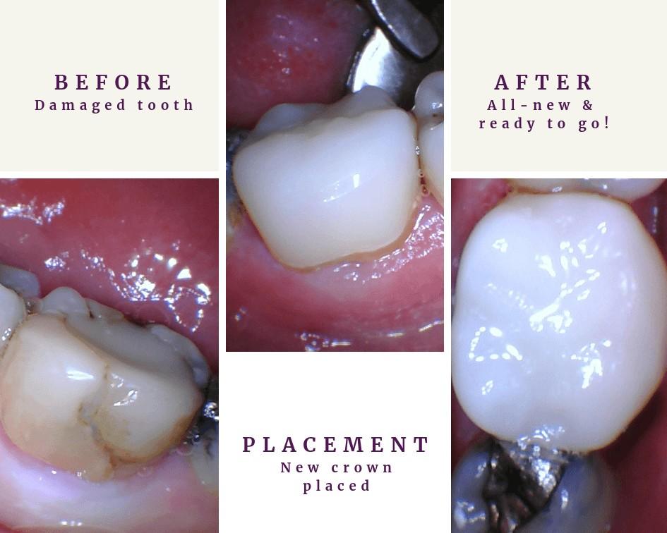 Same Day Cerec Crown before and after